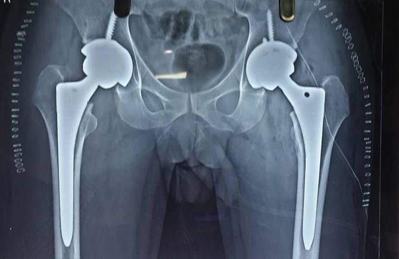 Bilateral hip avascular necrosis patient operated