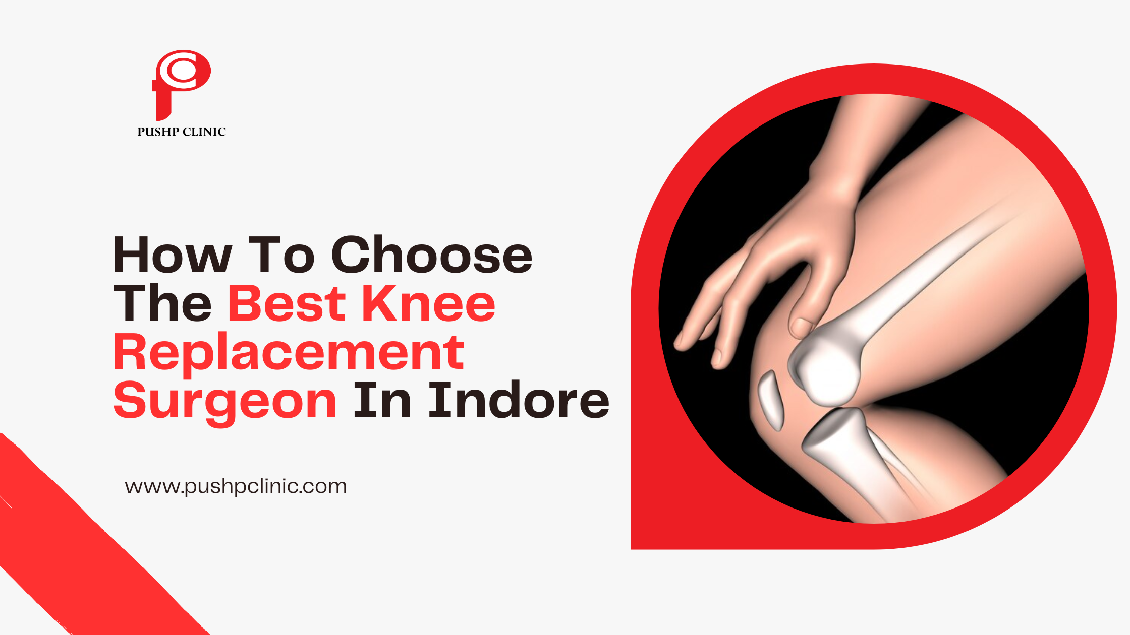 Knee Replacement Surgery in Indore